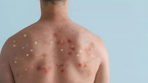 Israel warns new cases of monkeypox, measles