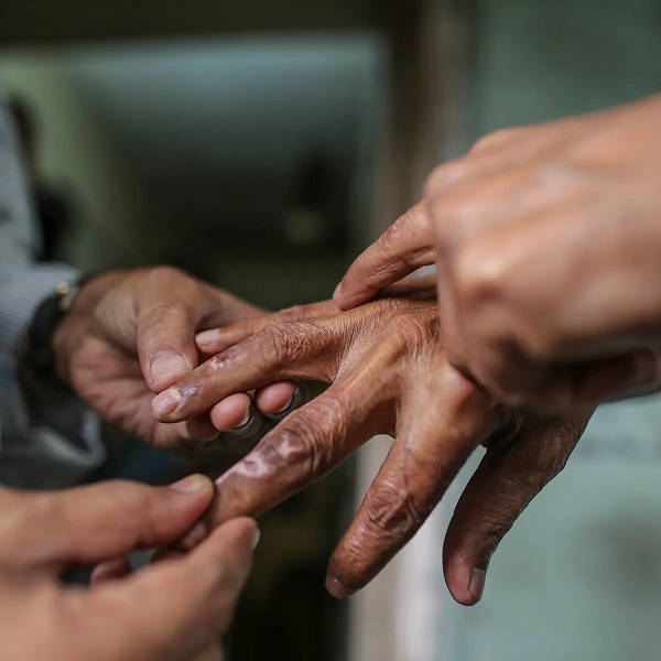 Rights experts warns stigma, shame hounds leprosy victims
