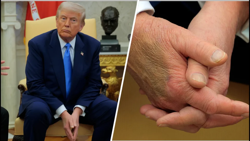 Trump diagnosed with ‘chronic venous insufficiency’ says WH press