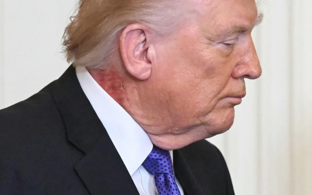 Neck Rash Sparks Questions on Trump’s Health